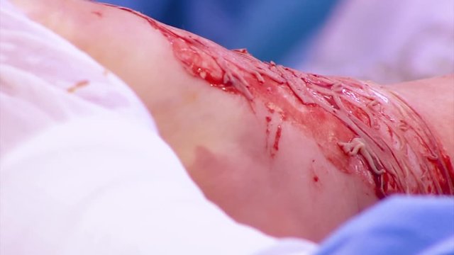 Surgical transplantation of the skin of the child. The treatment of burns.