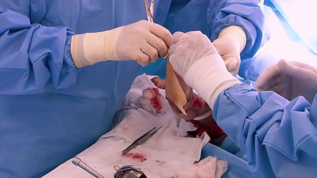 Surgical transplantation of the skin of the child. The treatment of burns.