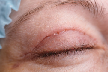 Blepharoplasty of the upper eyelid.