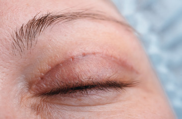 Blepharoplasty of the upper eyelid.