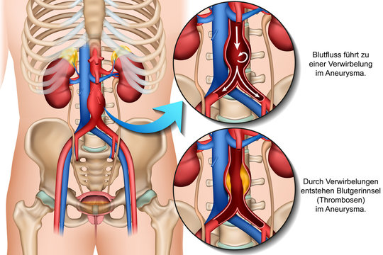 Entstehung eines Bauchaortenaneurysmas, Aneurysma vektor Illustration
