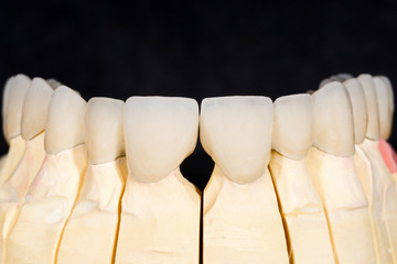 Fototapeta na wymiar Dental zirconia bridge