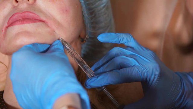 Close up shot of face of a middle-aged woman, where botulinum is injected by the doctor of privat clinic to smooth out facial wrinkles, as well as lip-chin wrinkles