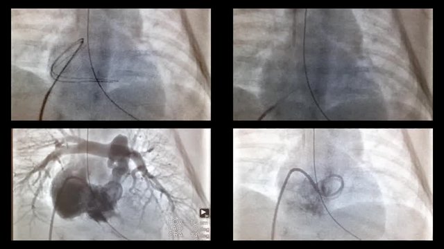 Catheterization of the heart and vessels in the X-ray