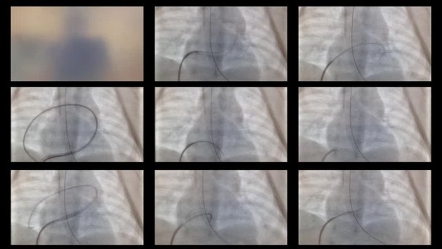 Catheterization of the heart and vessels in the X-ray