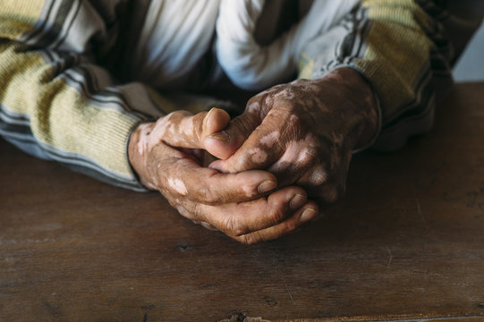 Close up of vitiligo hands of a senior man