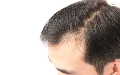 Fototapeta premium Closeup young man serious hair loss problem for health care shampoo and beauty product concept