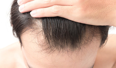 Closeup young man serious hair loss problem for health care shampoo and beauty product concept