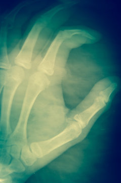 Hand X-ray on dark background medical concept.