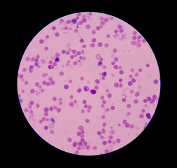 Reticulocyte with red blood cells on blood smear.