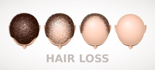 Hair loss. Set of four stages of alopecia - obrazy, fototapety, plakaty