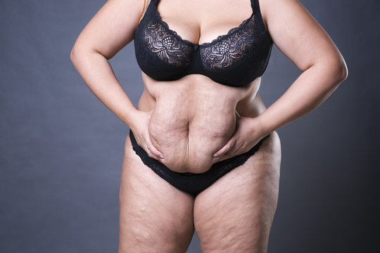 Woman with fat abdomen, overweight female stomach, stretch marks on belly closeup