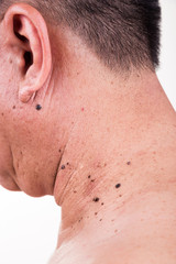 Fototapeta premium Multiple mole on neck and shoulder of Asian male