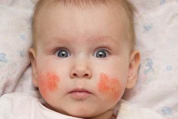 Surprised little baby girl with an allergic rash on her cheeks lies on her back