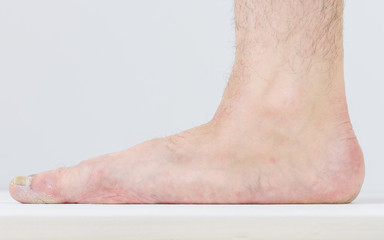 Fototapeta premium Men's right leg with severe symptoms of diseases of the feet.