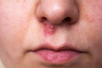 Fototapeta premium young girl with skin problem