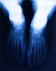 X-ray human's ankle with arthritis , top view.