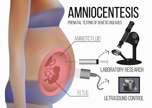 Amniocentesis. Ultrasound control