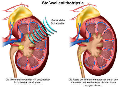 Stosswellenlithotripsie vektor illustration mit Erklärung auf deutsch