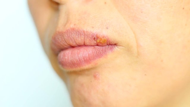 Herpes labialis, also called cold sores among other names, is a type of herpes simplex occurring on the lip, ie an infection caused by herpes simplex virus (HSV)