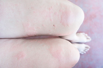 Rash from allergic infection, eczema dermatitis