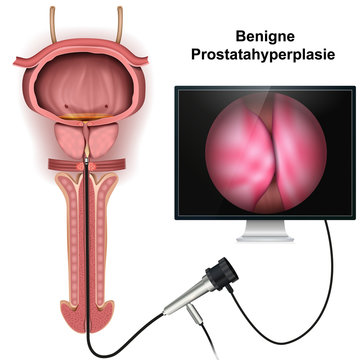 Benigne prostatahyperplasie, medical vector illustration