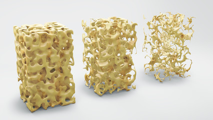 Bone structure 3d illustration, normal and with osteoporosis - obrazy, fototapety, plakaty