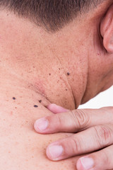 Finger embrace mole on neck and shoulder of Asian male