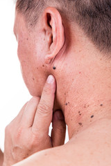 Finger embrace mole on neck and shoulder of Asian male