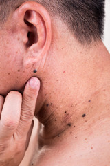 Obraz premium Finger embrace mole on neck and shoulder of Asian male