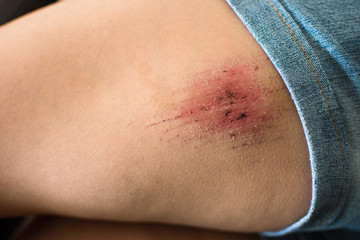 Sport injury - painful knee wound accident. Close up on an bleeding scraped human knee after run...