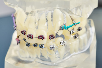 Human teeth orthodontic dental model with implants, dental braces