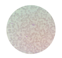 Microscopic examination of thin blood films smear from malaria infected patients present morphology of malaria parasite in human red blood cells.