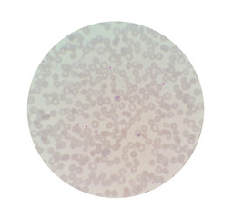Microscopic examination of thin blood films smear from malaria infected patients present morphology of malaria parasite in human red blood cells.