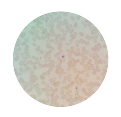 Microscopic examination of thin blood films smear from malaria infected patients present morphology of malaria parasite in human red blood cells.