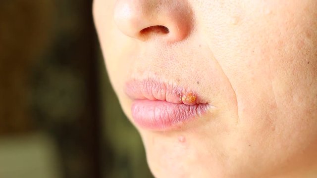 Herpes simplex is a viral disease caused by the herpes simplex virus. Oral herpes involves the face or mouth