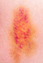 Fototapeta premium Closeup on a Bruise
