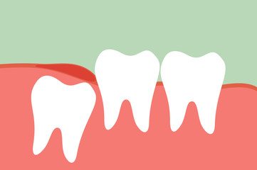 wisdom tooth