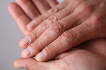 Male hands close up, dry skin, winter skin care concept