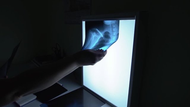 The doctor looks at the X-ray. The image shows a clavicle, ribs, and lungs. The process of healing a fracture with a stent in the bone. A dark room