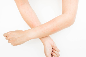 Rash allergy from touching arms ,eczema, Dermatitis
