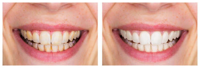 Whitening - Dental care, a beautiful smile and teeth whitening treatment before and after.