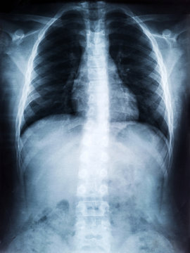 X-ray Film of Human Spine for Medical Diagnosis