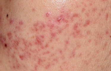 closeup skin problems, nodular cystic acne skin