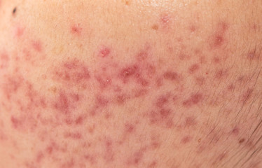 closeup skin problems, nodular cystic acne skin