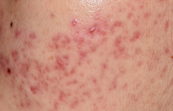 closeup skin problems, nodular cystic acne skin
