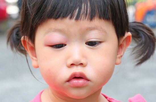 Asian baby girl eye swell, Allergy after mosquitoes biting at eye small girl