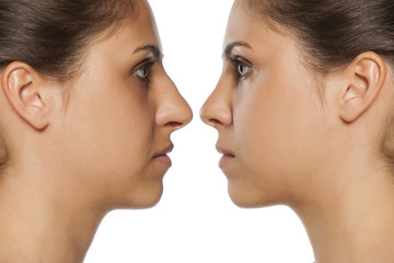 comparative portrait of a young woman before and after nose correction