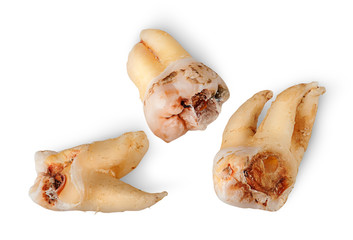 Closeup three teeth with caries