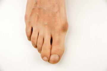 Foot with a bunion